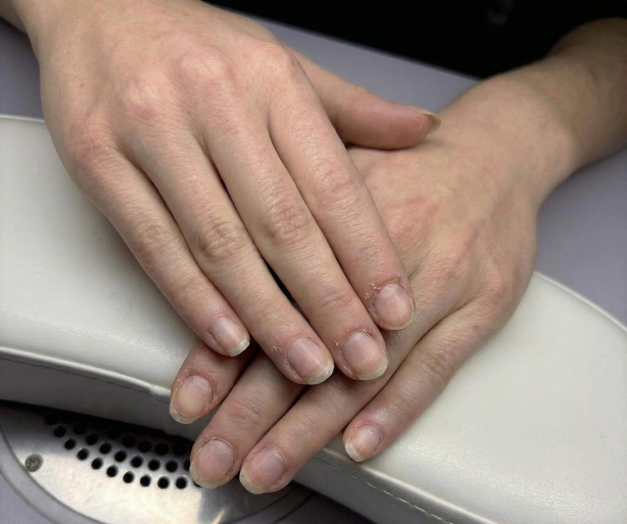 Female hands with nails before manicure, visible dryness